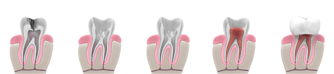 Root Canal Therapy Process | All About Family Dental | General & Family Dentist | SW Calgary