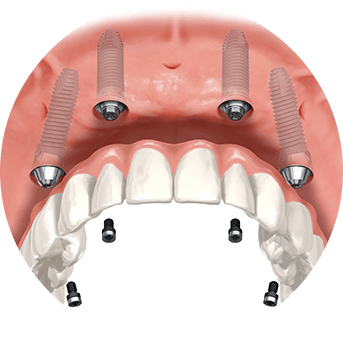 All-on-4® Dental Implants | All About Family Dental | General & Family Dentist | SW Calgary