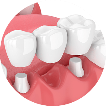 Dental Bridges | All About Family Dental | General & Family Dentist | SW Calgary