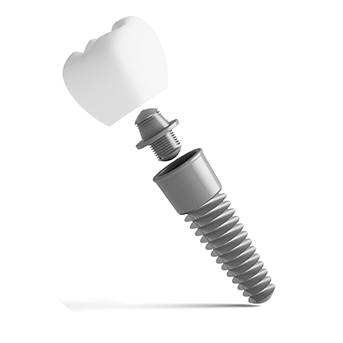 Dental Implant Crowns | All About Family Dental | General & Family Dentist | SW Calgary