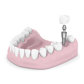 Dental Implant Surgery | All About Family Dental | General & Family Dentist | SW Calgary