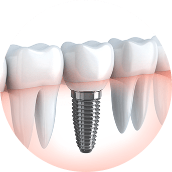 Dental Implants | All About Family Dental | General & Family Dentist | SW Calgary