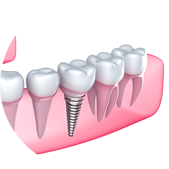 Implant Dentistry | All About Family Dental | General & Family Dentist | SW Calgary