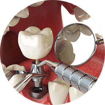 Implant Placement Surgery | All About Family Dental | General & Family Dentist | SW Calgary