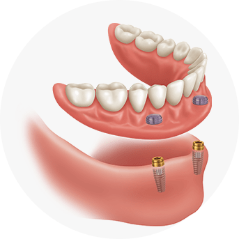 Overdenture Implants | All About Family Dental | General & Family Dentist | SW Calgary