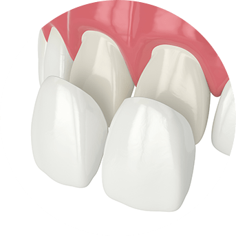 Porcelain Veneers | All About Family Dental | General & Family Dentist | SW Calgary