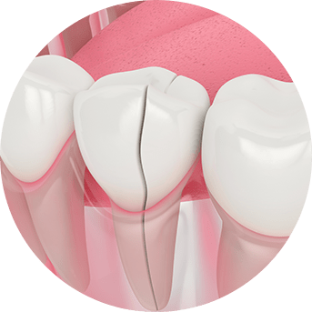Reasons for a Dental Crown | All About Family Dental | General & Family Dentist | SW Calgary