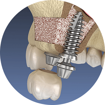 Sinus Lift Surgery | All About Family Dental | General & Family Dentist | SW Calgary