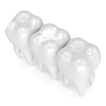 Tooth Colour Match Fillings | All About Family Dental | General & Family Dentist | SW Calgary