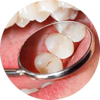 Tooth Colour Match Fillings | All About Family Dental | General & Family Dentist | SW Calgary