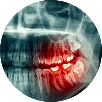 Wisdom Teeth Extraction | All About Family Dental | General & Family Dentist | SW Calgary